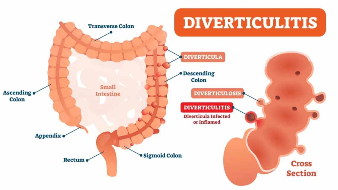 Дивертикулёзы и дивертикулиты - причины, симптоматика, лечение
